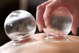 Cupping therapy for back pain
